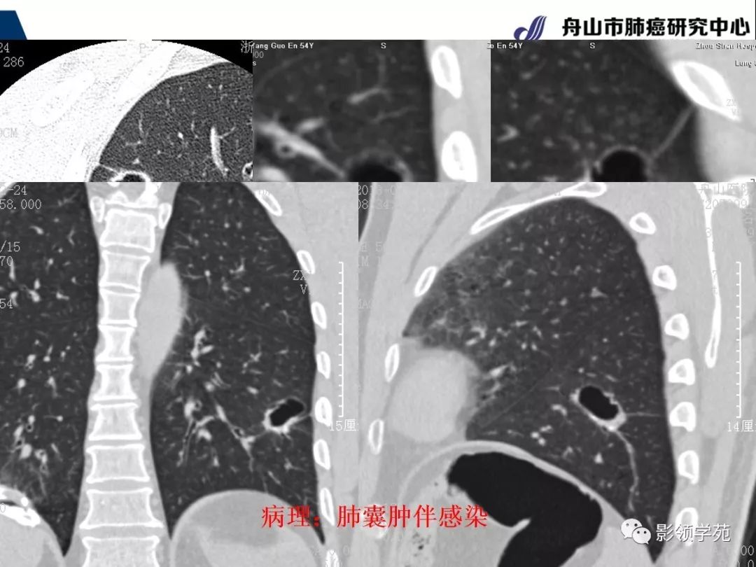 經典課堂早期周圍型肺鱗癌ct診斷及鑑別診斷上