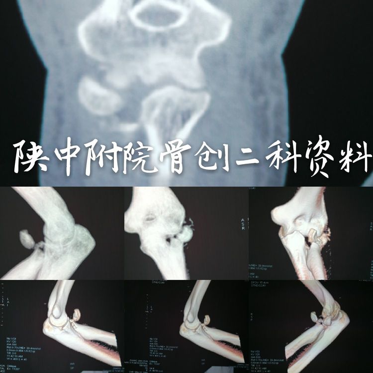 左肘關節外側副韌帶損傷4.左尺骨冠狀突骨折5.