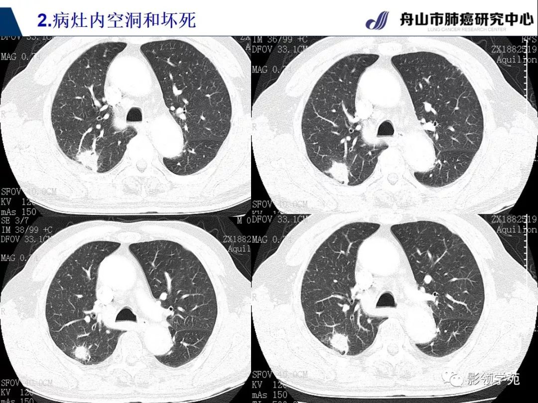 周围型肺癌ct图片图片