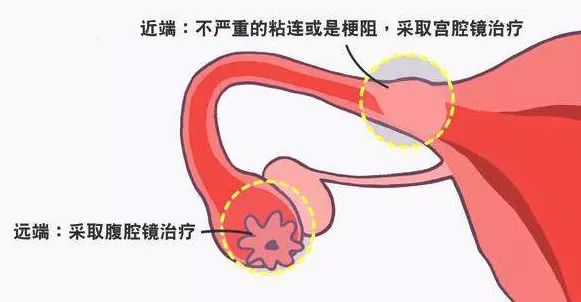 腹腔鏡檢查是診斷輸卵管通暢度的金標準.