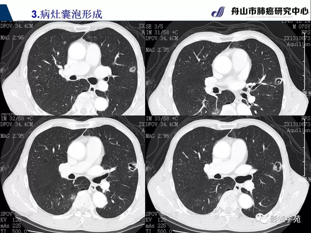 經典課堂早期周圍型肺鱗癌ct診斷及鑑別診斷上