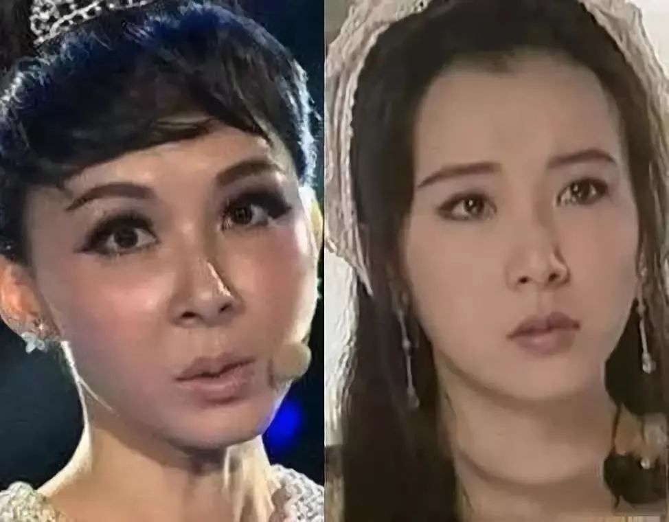 李小璐的脸崩了那些被玻尿酸坑害quot的女明星怎么了