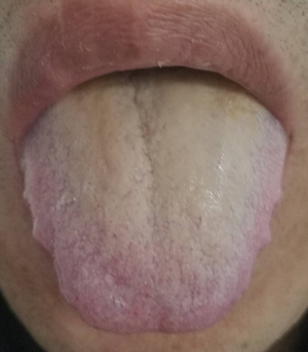肾阴虚舌头的图片图片