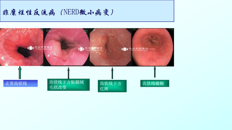 科普三分治療七分養護快來學學胃食管反流病如何養護吧