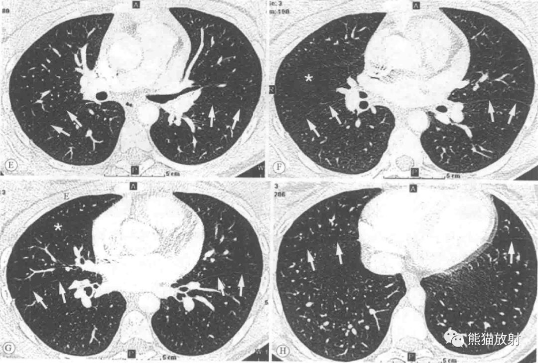 右肺叶间裂CT示意图图片