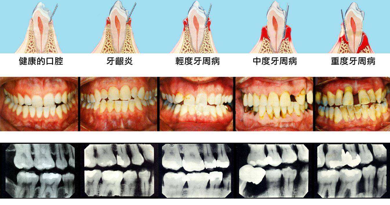 牙周病不及时处理会造成怎样的后果?