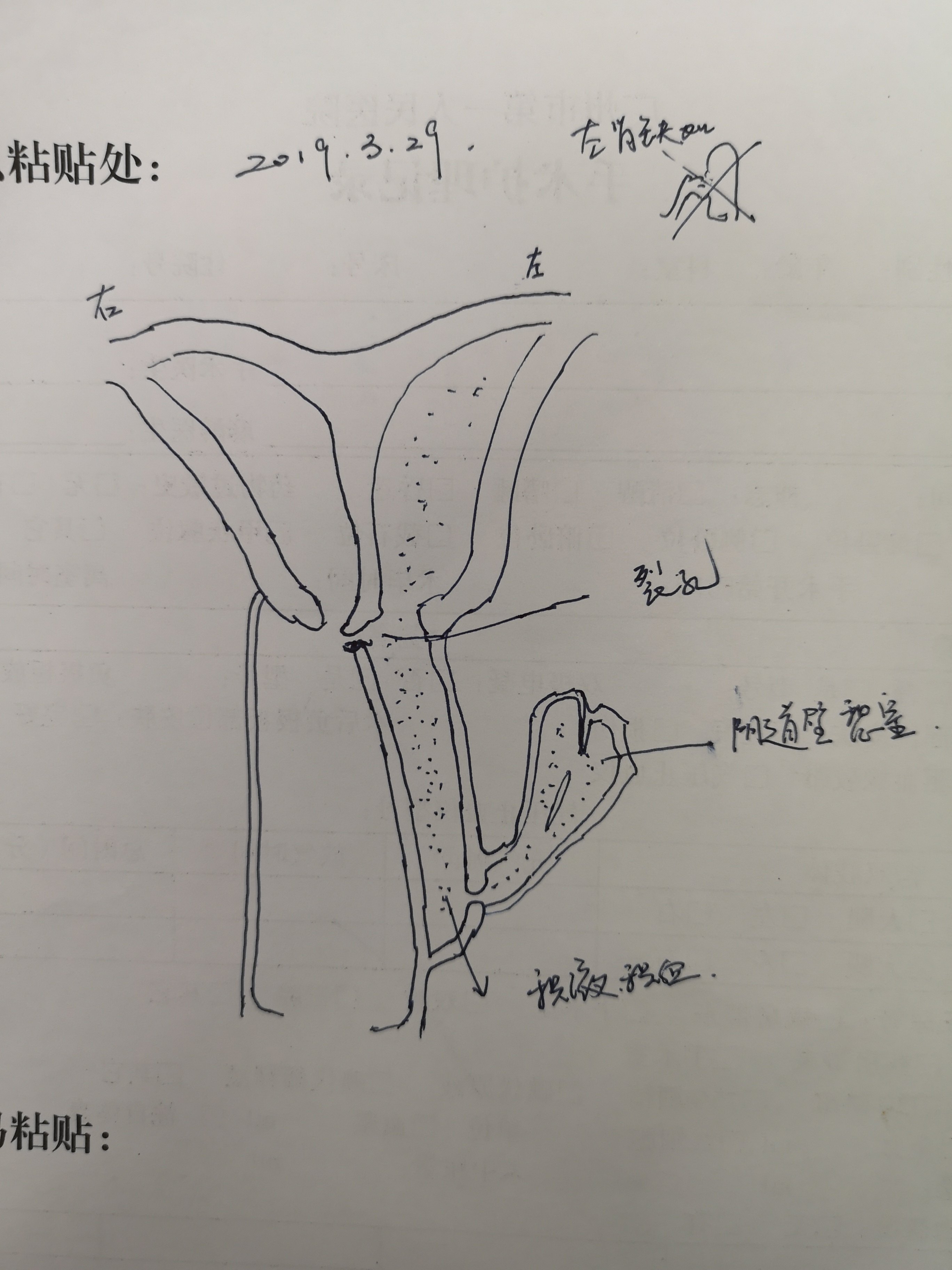 不破壞處女膜,切除陰道隔 (原創)_檢查