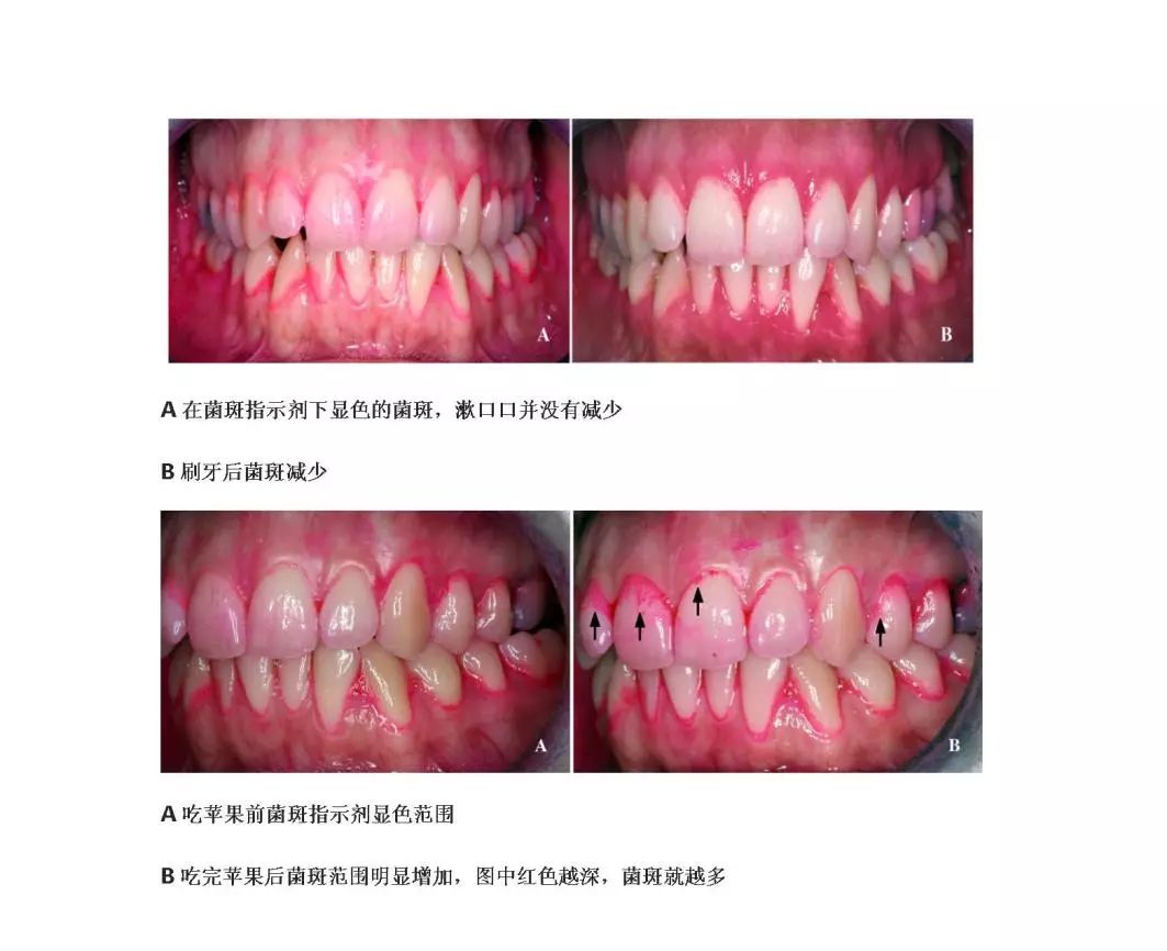 其实就是在牙齿表面不能被水冲去的一层细菌性生物膜,它是所有牙齿