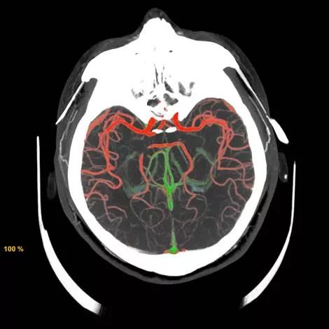 头部螺旋ct图片