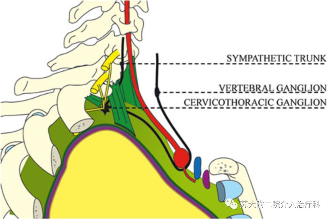 圖10 星狀神經節,也稱為