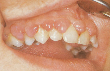 对于牙龈上长脓包,可能很多人以为是简单的牙龈发炎,吃点消炎药就没事