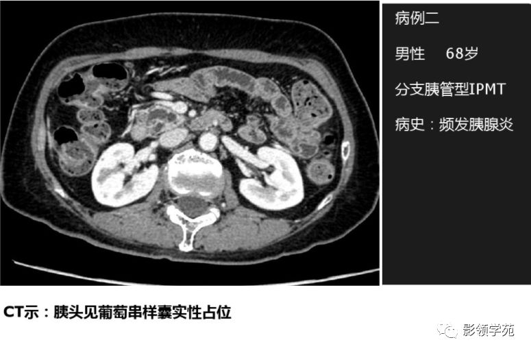 胰腺常見囊性腫瘤的ct表現及鑑別診斷