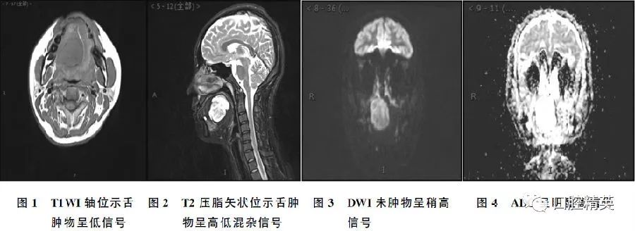 舌部良性肿瘤神经鞘瘤的mri表现1例