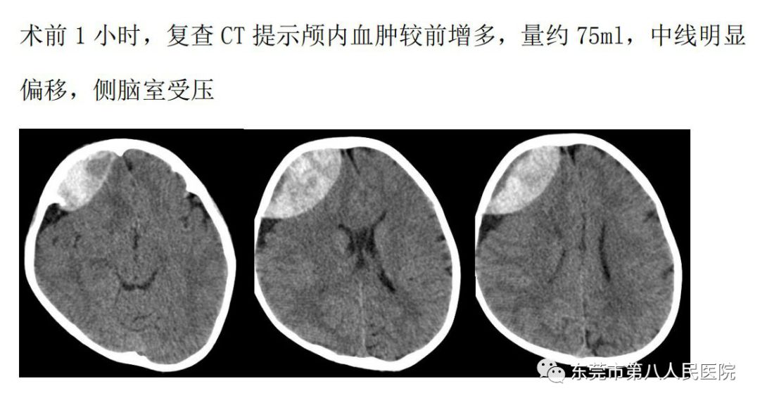 生命前線驚險三歲兒童摔倒致大量硬腦膜外血腫