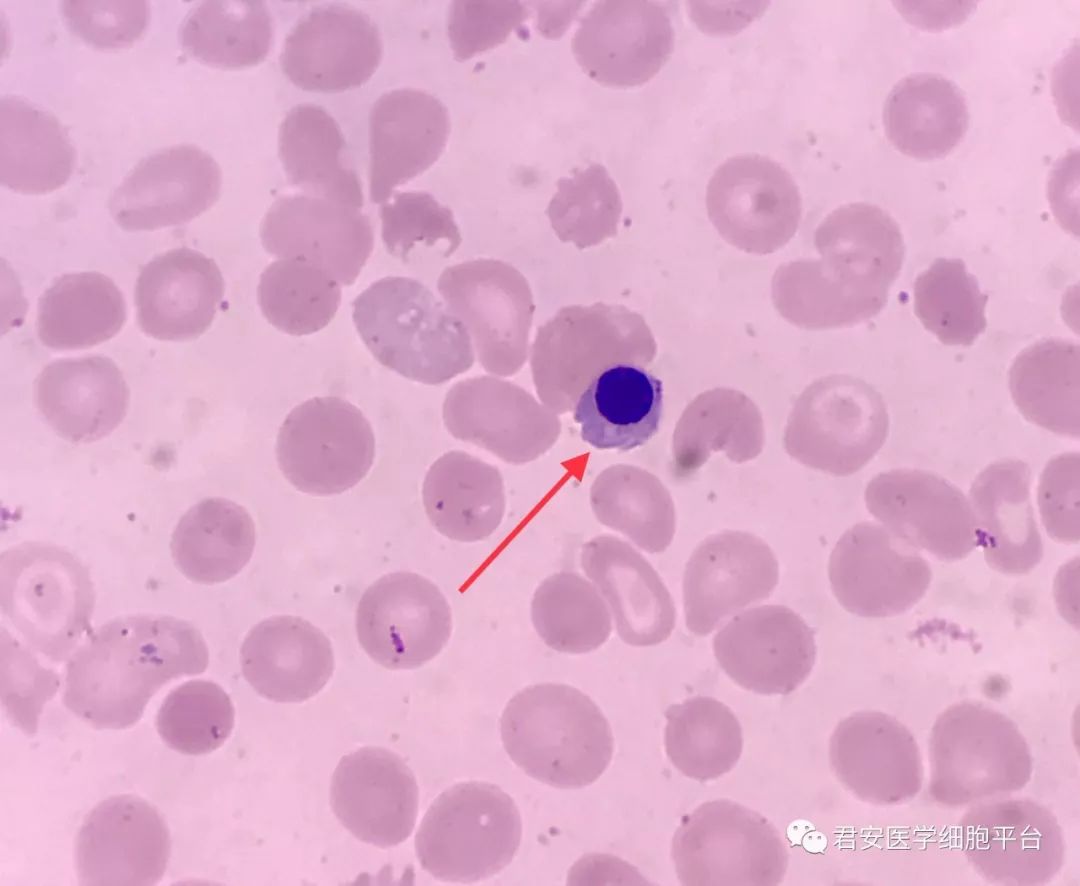 ▼「晚幼红细胞」形态特征:细胞胞体呈圆形或类圆形;胞浆量较多,与
