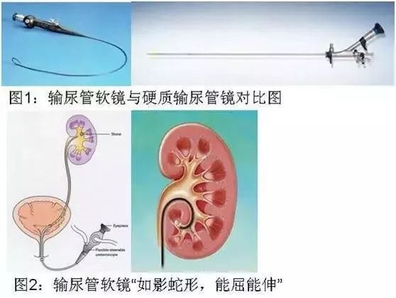输尿管插管术图片