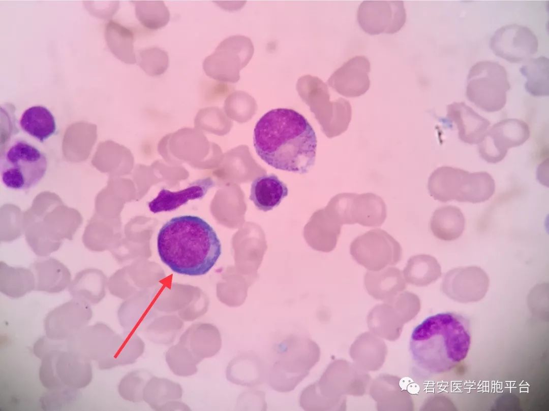 ▼「早幼红细胞」形态特征:细胞胞体呈圆形;胞浆量多,呈透明蓝或深
