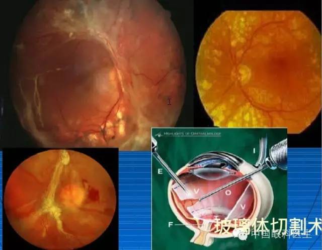 糖尿病視網膜病變眼部表現及其治療與預防