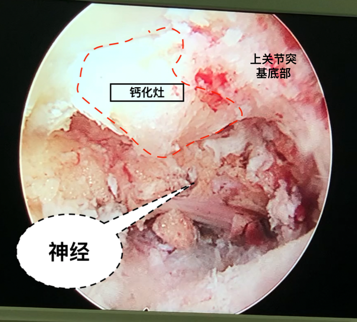 腰椎管狹窄還有韌帶鈣化了內鏡如何處理原創