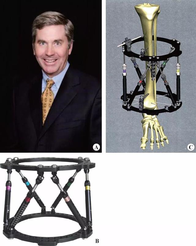 taylor支架当今矫形外科领域中最有前景的一种外固定器