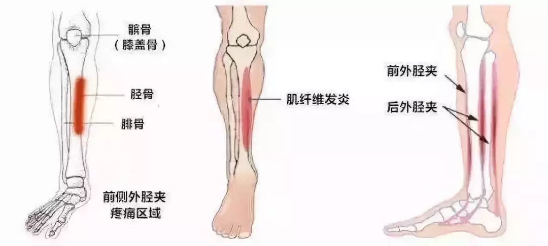 远离骨膜炎的 痛 看这里 训练