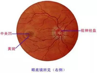 视网膜变性,如格子样变性,囊样变性,铺路石样变性,特别容易形成视网膜