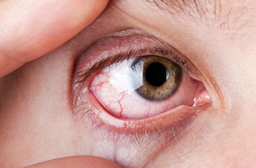 其实引起出现红血丝的原因很多,红血丝也可算是眼睛健康的警报器