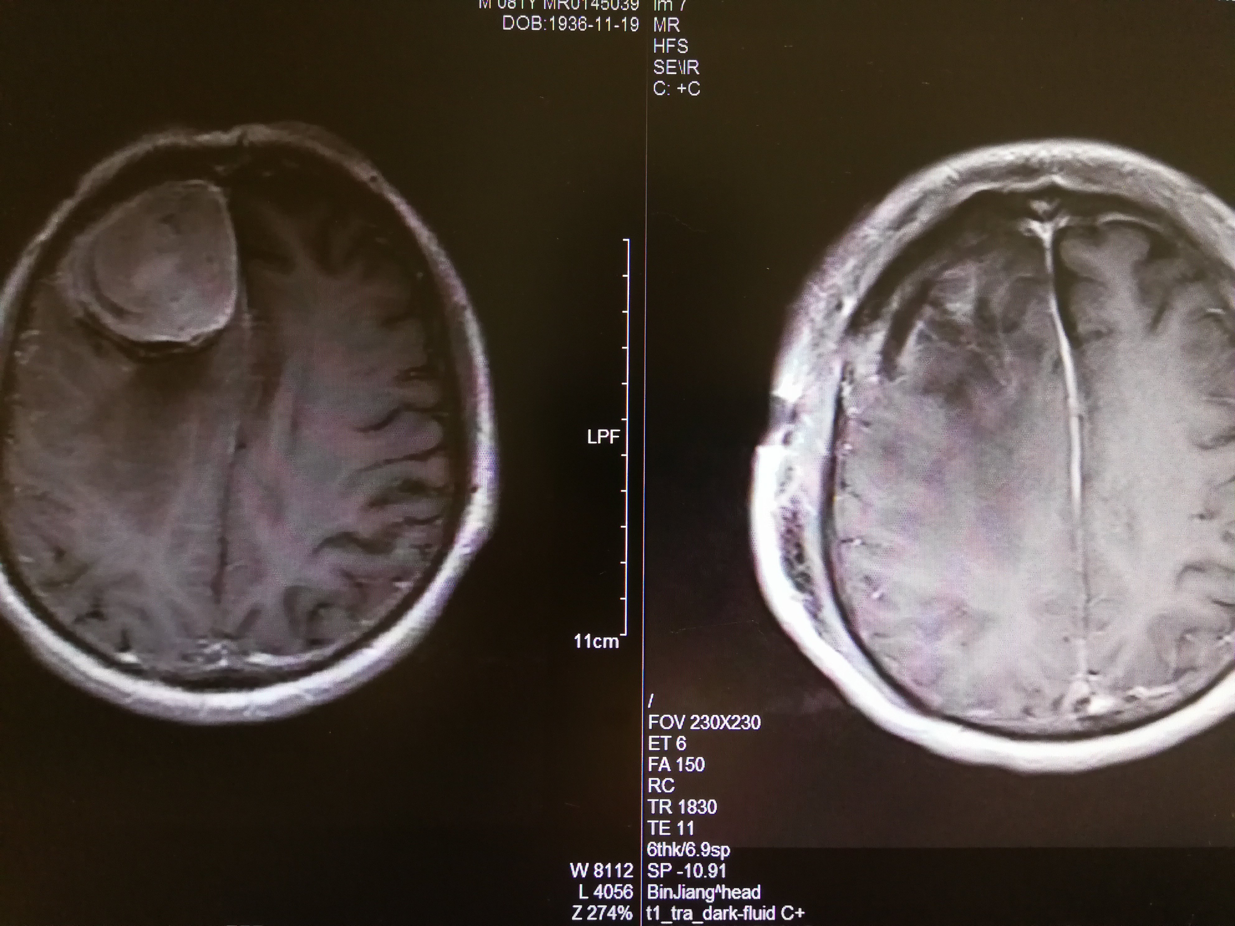 1,凸面脑膜瘤:顾名思义肿瘤生长于脑表面的脑膜上,包括大脑与小脑