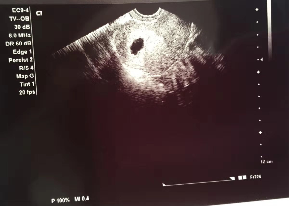 五周孕囊图片图片
