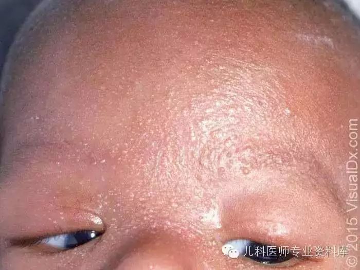 6大新生儿面部疱疹的鉴别与治疗!