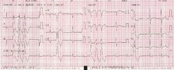 每次体检均提示室早二连律,三联律,门诊查动态心电图提示频发室性早搏
