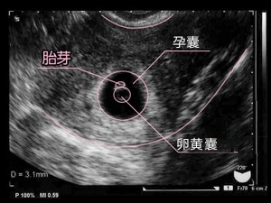 怀孕5周了没看见孕囊是怎么回事 这3个原因提前了解 好放心 检查