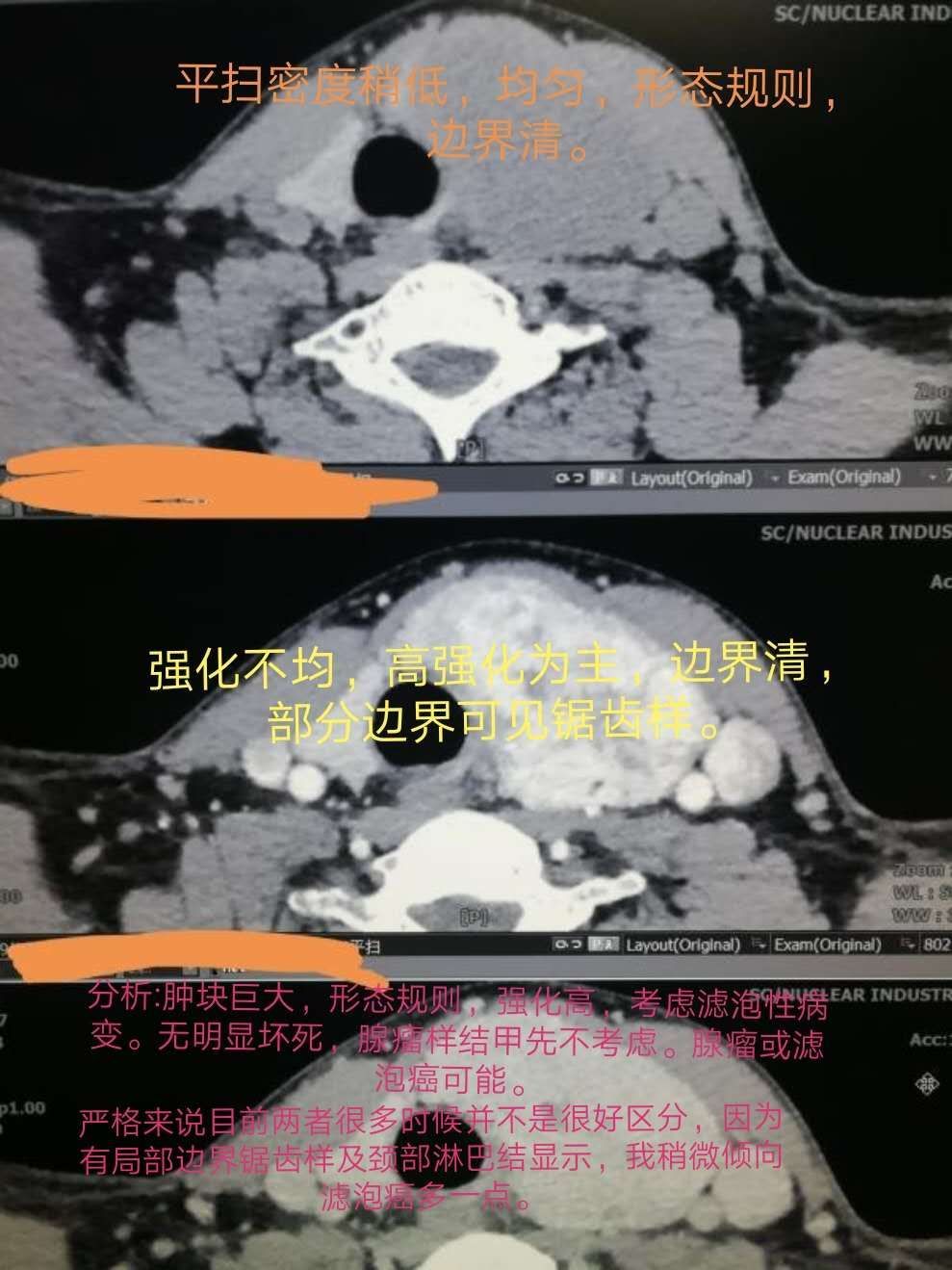 甲状腺ct扫描范围图片