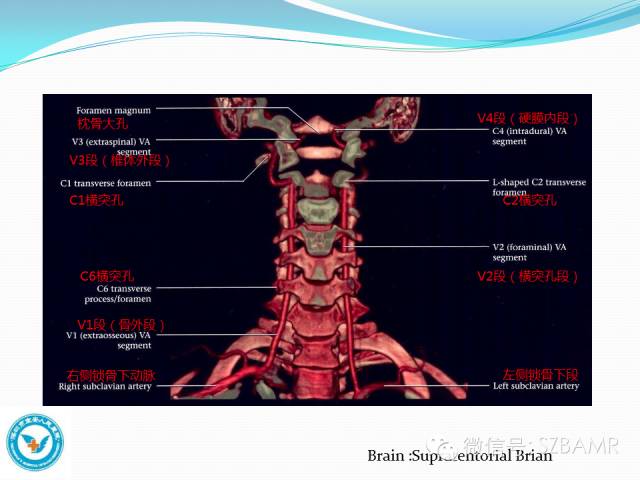 椎-基底動脈系統ct,mr及dsa影像解剖
