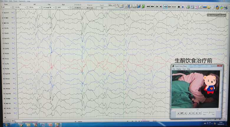 生酮前的腦電圖(我院):間歇期:1.慢波,瀰漫性 2.