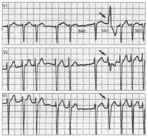 室上性激動下傳激動心室時發生室內差異性傳導現象