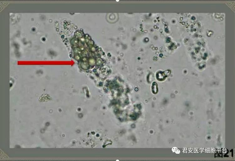 混合细胞管型图片