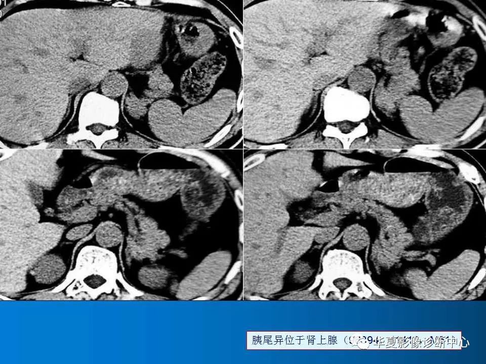 胰腺ct断层解剖图片