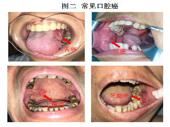 口腔溃疡恢复过程图图片