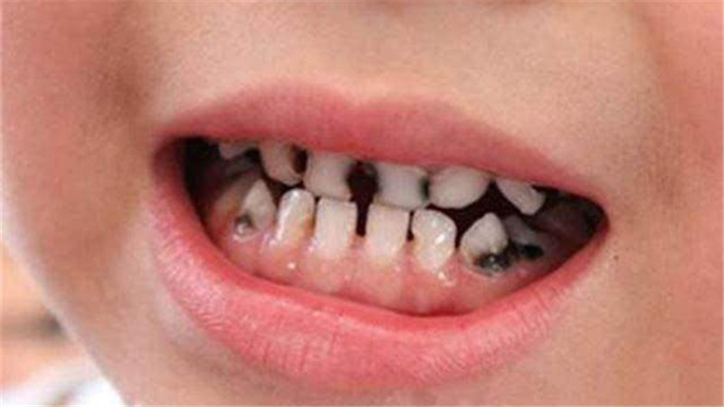 小孩牙齿发黑是缺钙吗图片