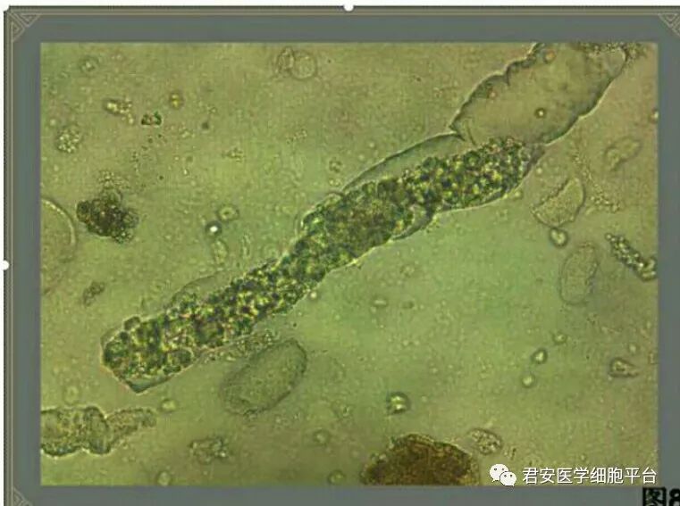 混合细胞管型图片