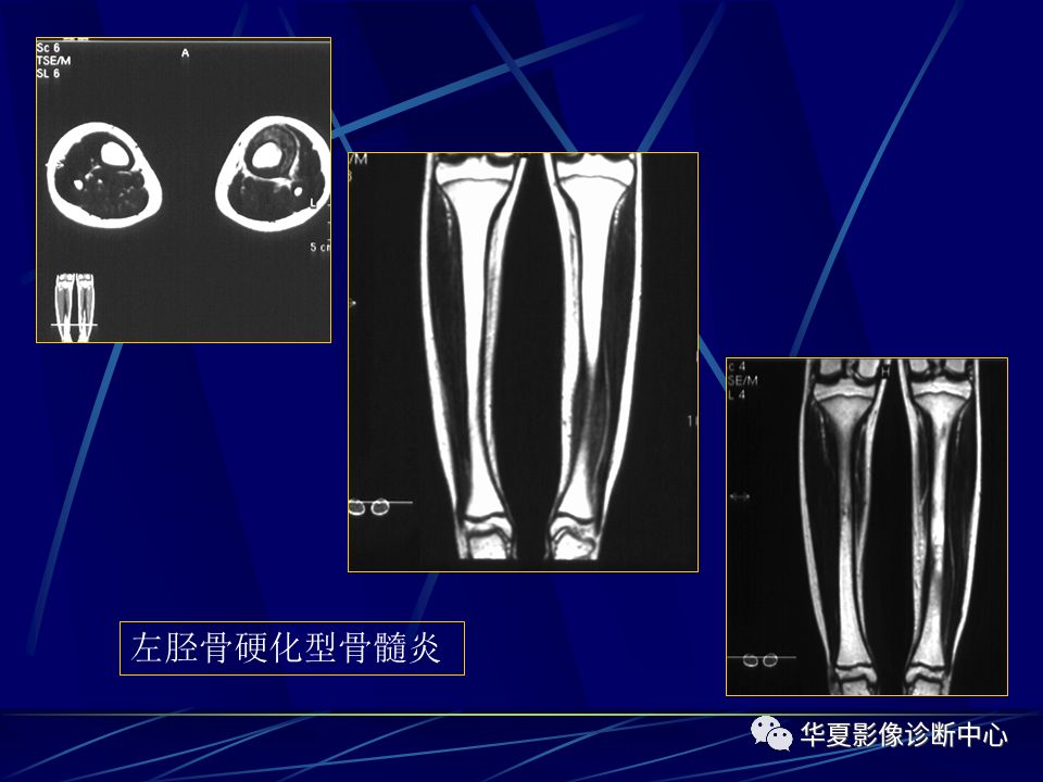 骨化膿性骨髓炎的影像學診斷