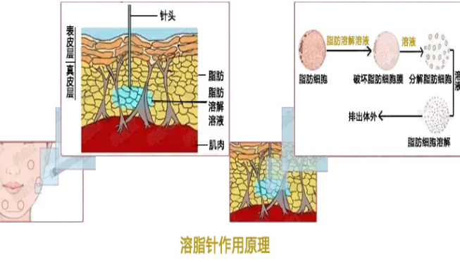 肚子溶脂针画点图图片