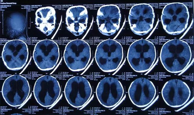 先天性脑积水宝宝 应该如何治疗才能不影响孩子生长发育