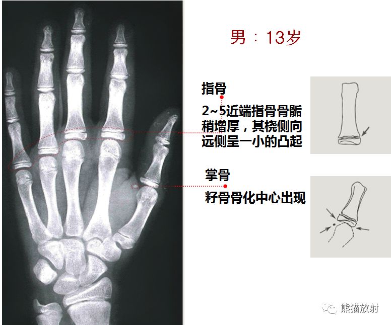 骨龄x线对照图图片