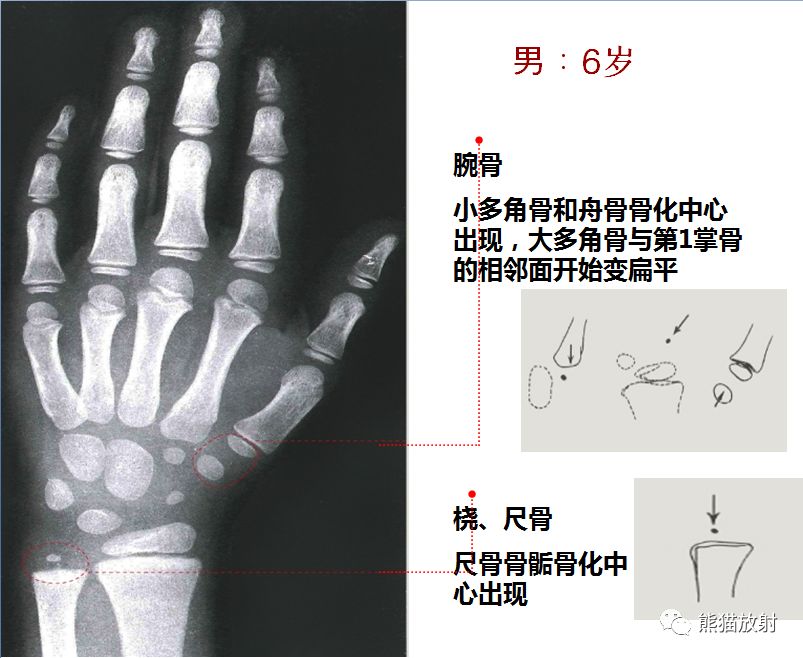 收藏丨骨龄图谱方便随时对照