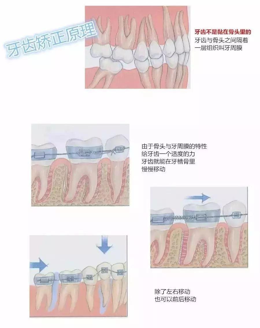 矫正牙齿的步骤跟过程图片