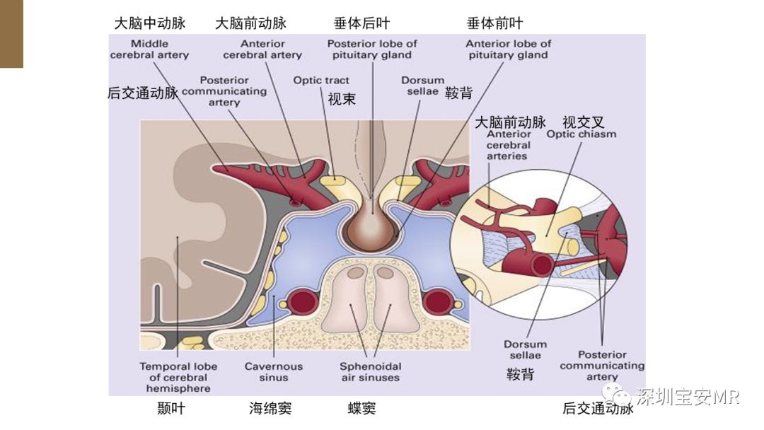 垂体窝解剖图图片
