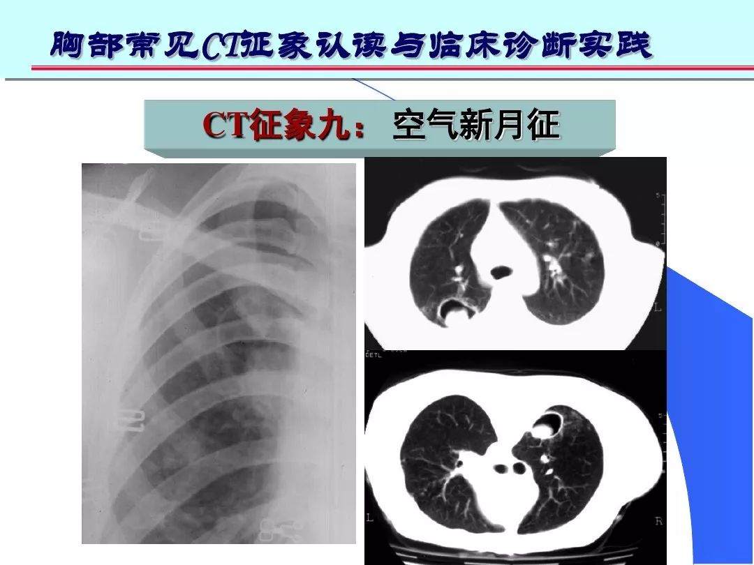 空气新月征曾认为是曲霉菌球的特异征象,特点是随着体位的变动,空洞