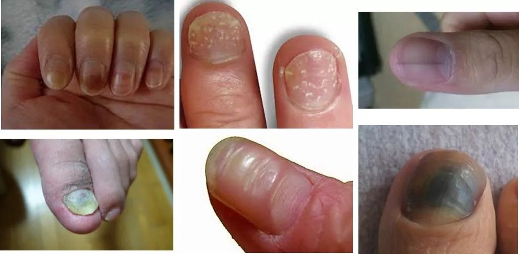 湿疹指甲演变过程图图片
